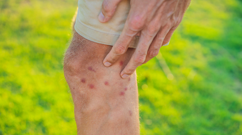 A man standing in grass scratching bug bites on his leg