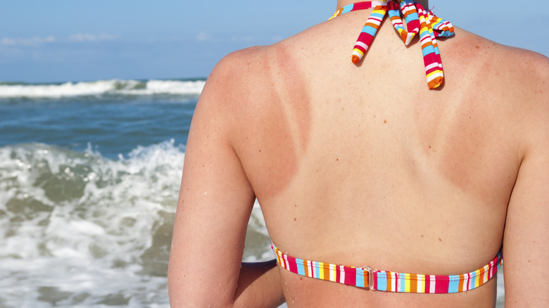 A woman's sunburned back